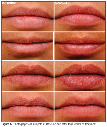 Clinical Assessment of a Combination Lip Treatment to Restore