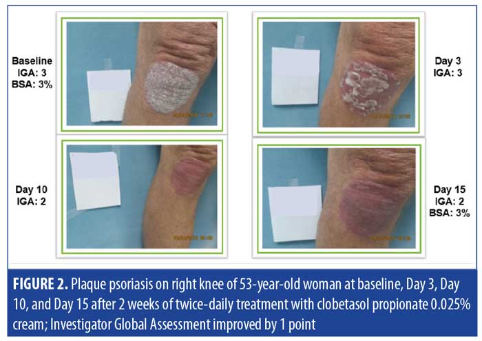 Treatment of Nail Psoriasis with a Two-Compound Formulation of Calcipotriol  plus Betamethasone Dipropionate Ointment | Semantic Scholar