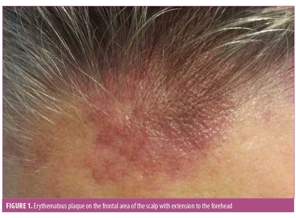Primary Cutaneous Angiosarcoma of the Scalp with Cranial Invasion in a  Patient with Metastatic Breast Cancer, JCAD
