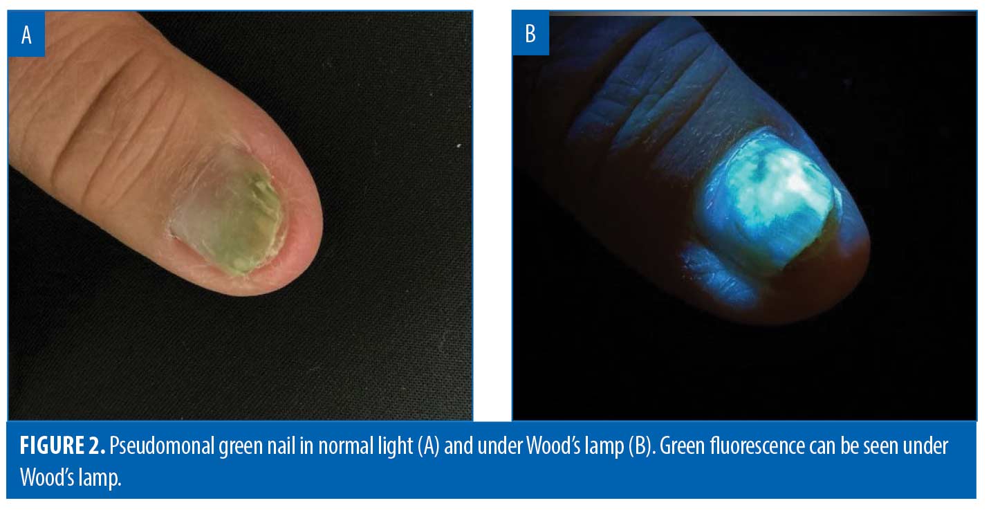Perspectives on the diagnosis & management of onychomycosis | CCID