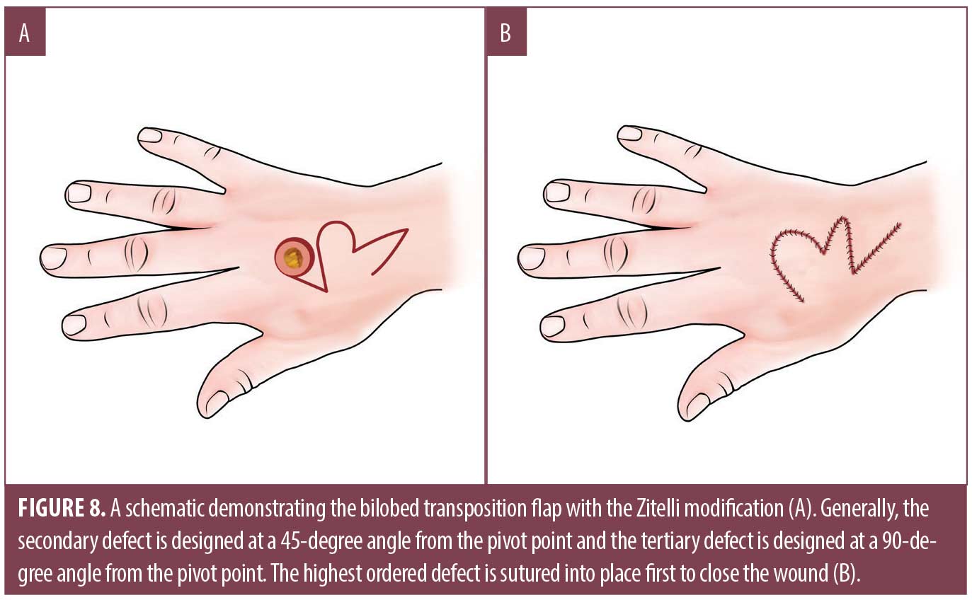 Vascular: Segmental ulnar artery excision and repair for aneurism with  emboli