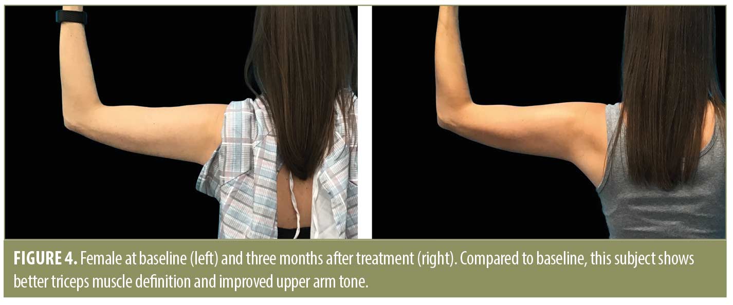 Bicep & Tricep Implants for Chicago men