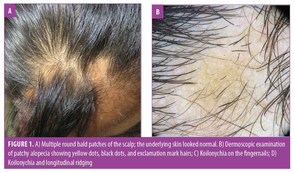 Van der Woude Syndrome and Alopecia Areata: More Than a Fortuitous  Association?