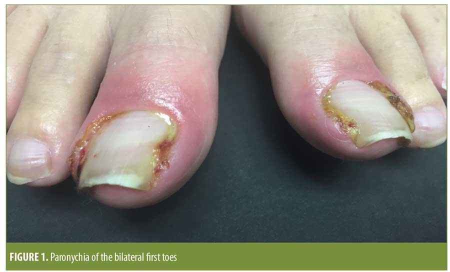 Onychomycosis | Nail Infection | Signs, Symptoms, Treatment - YouTube
