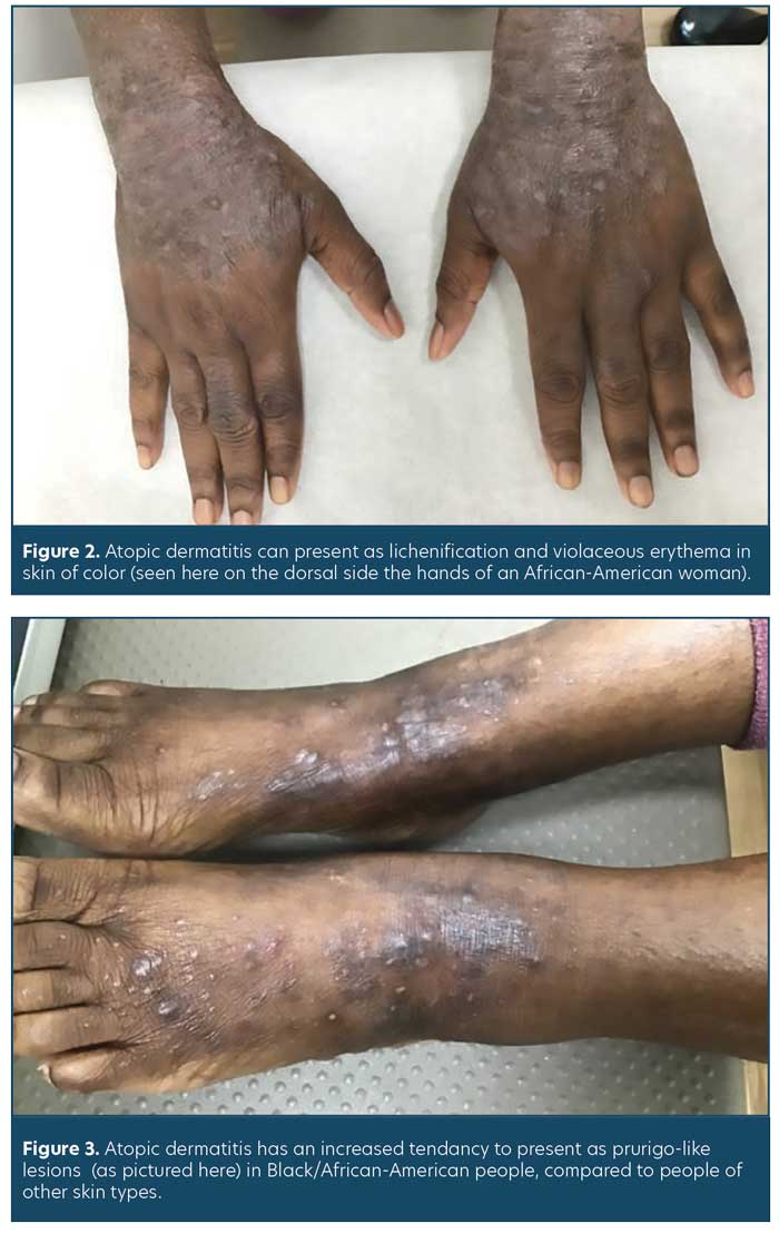 Dermatological Conditions In Skin Of Color— Managing Atopic Dermatitis
