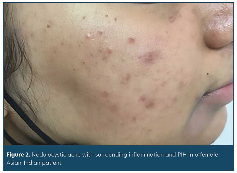Post-Inflammatory Hyperpigmentation (PIH) on the Skin