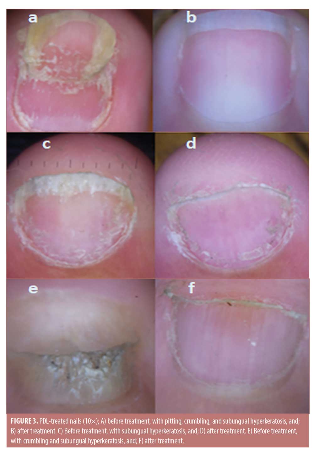Challenge of Nail Psoriasis: An Update Review | Clinical Reviews in Allergy  & Immunology