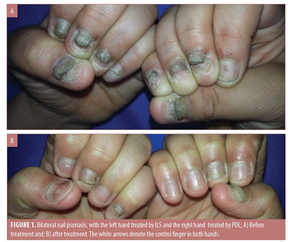 Psoriatic nail disease hi-res stock photography and images - Alamy