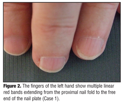 Nail lichen planus - Altmeyers Encyclopedia - Department Dermatology
