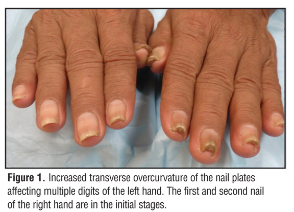 Surgical correction of severe bilateral thumb pincer-nail deformity. |  Semantic Scholar