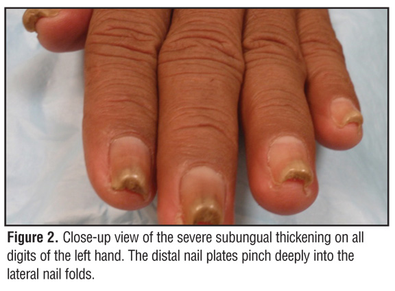 Treatment of Symptomatic Incurved Toenail with A New Device - J-Young Kim,  Jun Sic Park, 2009