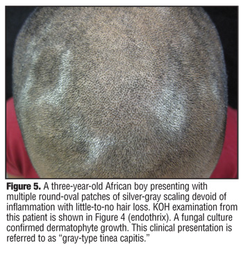 Tinea Capitis in 31 Year Old Adult Male: A Rare Entity